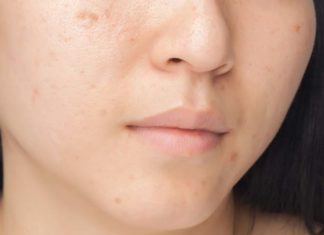 Likwidacja przebarwień – co warto o niej wiedzieć? Sprawdzamy!