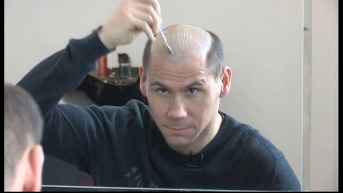 Przyklejanie Systemu Włosów