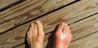 Co to jest płaskostopie przyczyny? Co to jest płaskostopie przyczyny?